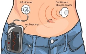 Automated insulin delivery technology.