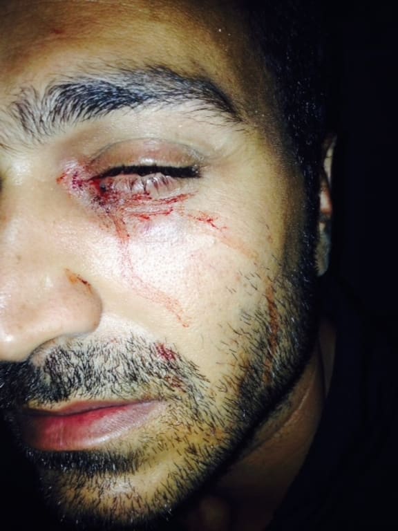 The Refugee Action Coalition says Iranian refugee Mehrzad has lost most of his vision after being attacked on Nauru.