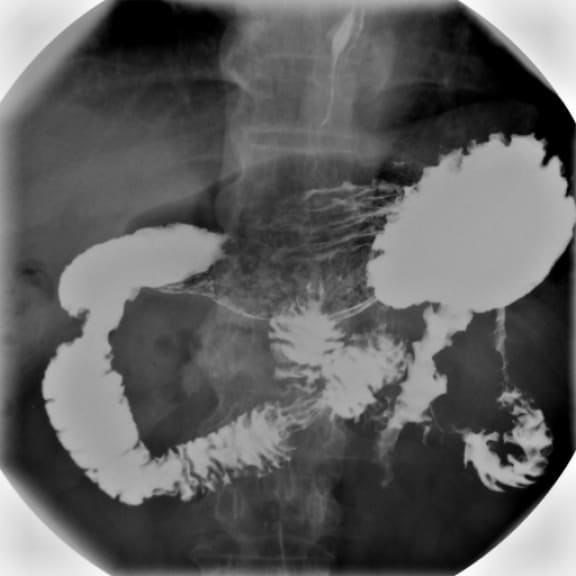 A barium meal examination showing the stomach and duodenum.