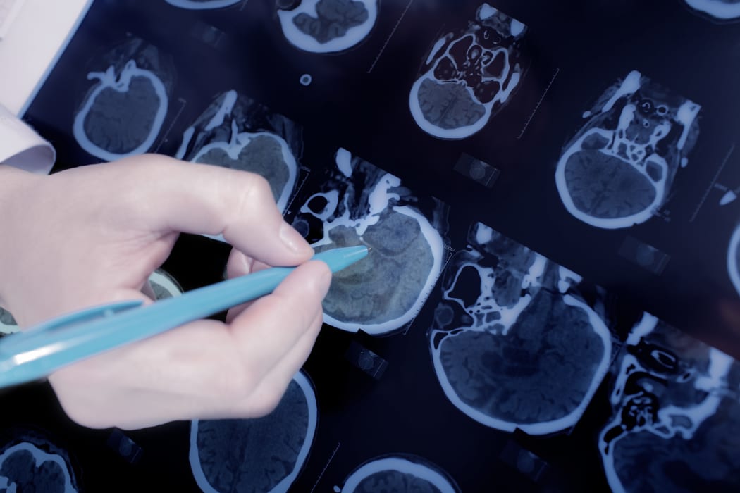 close-up of the doctor hand pointing to the brain CT