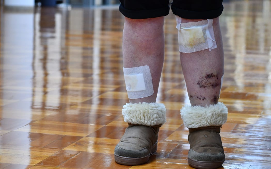 Suz Guet, attacked by three dogs in Rotorua, has shared her experience with Rotorua councillors.