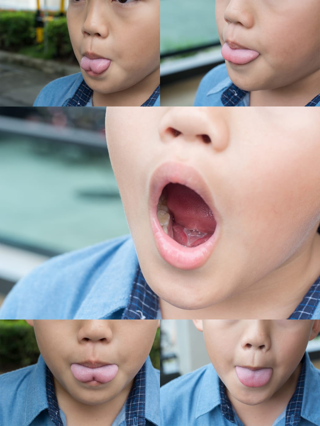 Ankyloglossia or tongue tie.