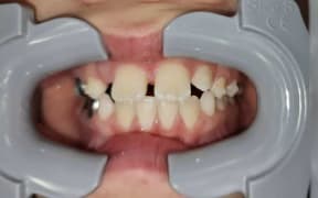 The boy's teeth when he was 10, before straightening treatment began at True Alignment Orthodontics and before all his baby teeth came out.