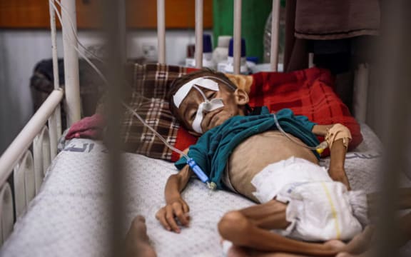 Aid organisations have said malnutrition centres are being overwhelmed by patients.(ABC News)