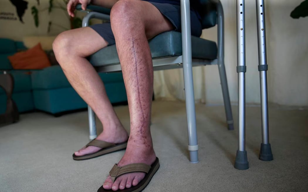 Heavy scars run from the knee to ankle on both sides of Leo Breva's leg and are a permanent reminder of his traumatic injury.
