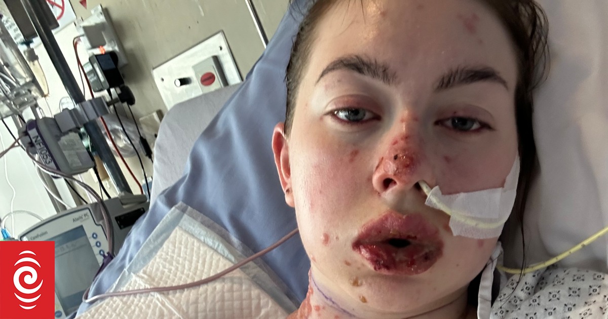 Palmerston North woman spent a month in hospital with Stevens-Johnson Syndrome after reaction to medication - Vimarsana News