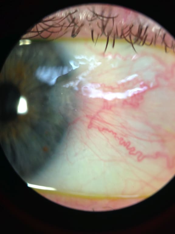 UV rays also cause pterygium, a growth on the surface of the eye