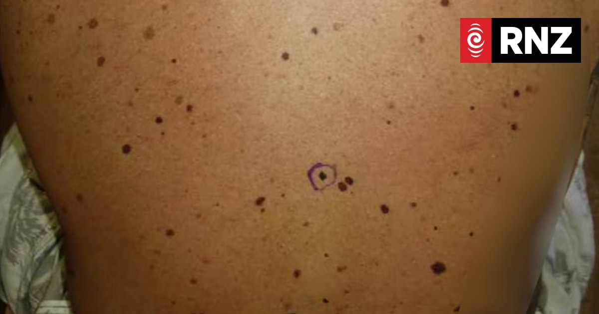 Abnormal moles seen developing in patients chasing perfect suntan by using  peptide melanotan-II
