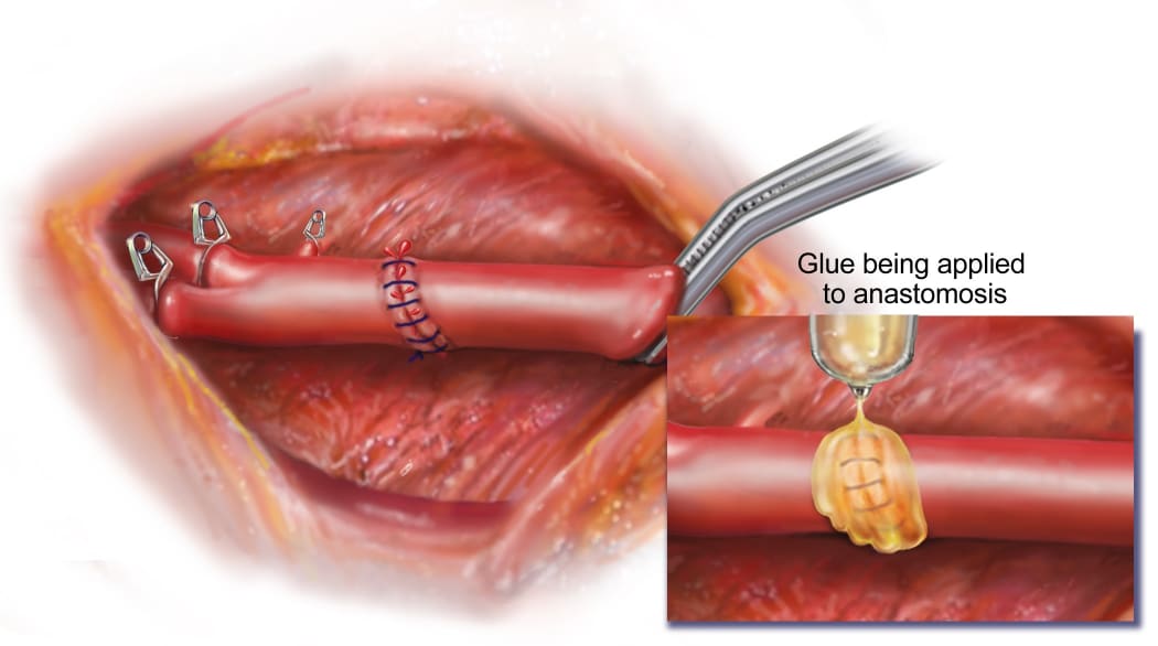 A surgical patch derived from nature to be used on child's growing heart 2
