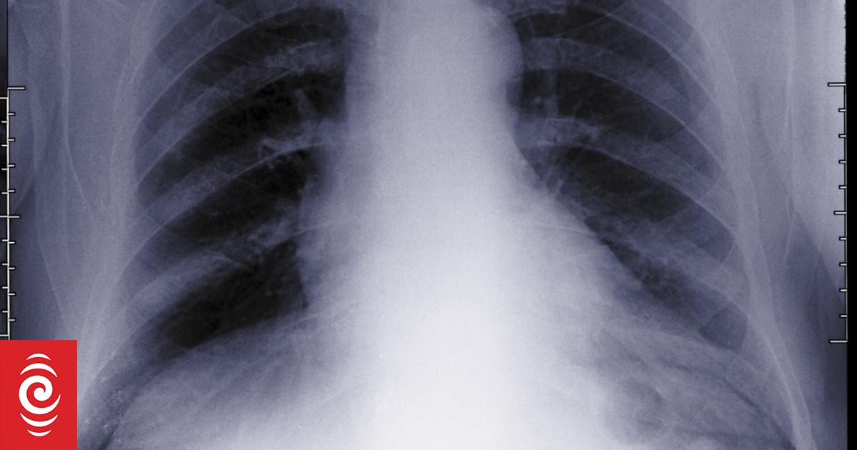 Woman's cancer diagnosis delayed after Waikato Hospital failed to follow up on x-ray - Vimarsana News