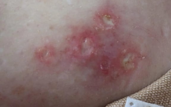 One of the rashes Sarah experienced which she believes was caused by glass fibres from her mattress.