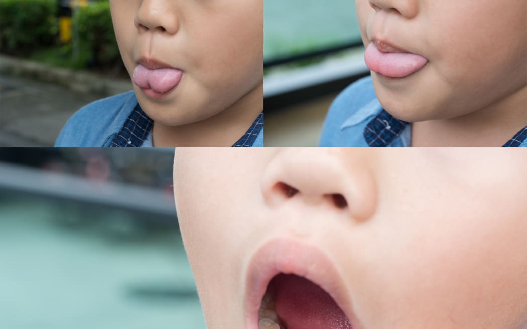Ankyloglossia or tongue tie.