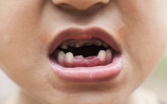 A child's mouth showing rotten and decaying teeth.