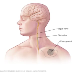 An illustration of the placement of a vague nerve stimulation implant