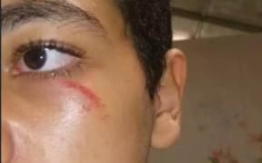 A teenage refugee on Nauru shows bruising under their left eye.