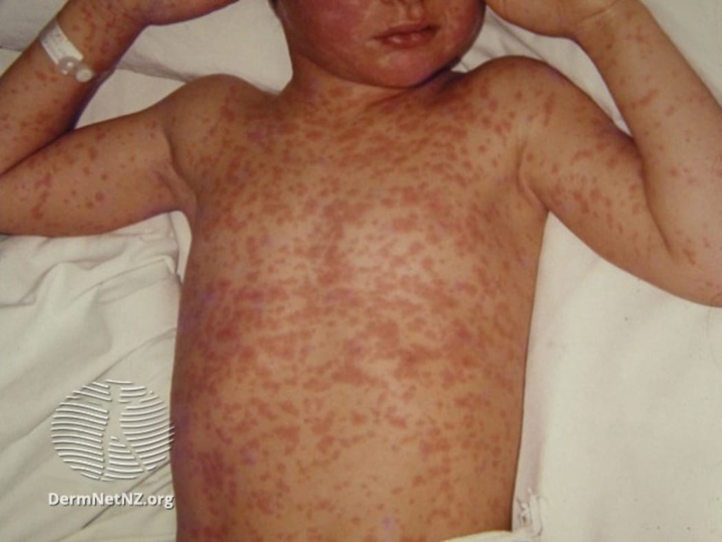A child with measles