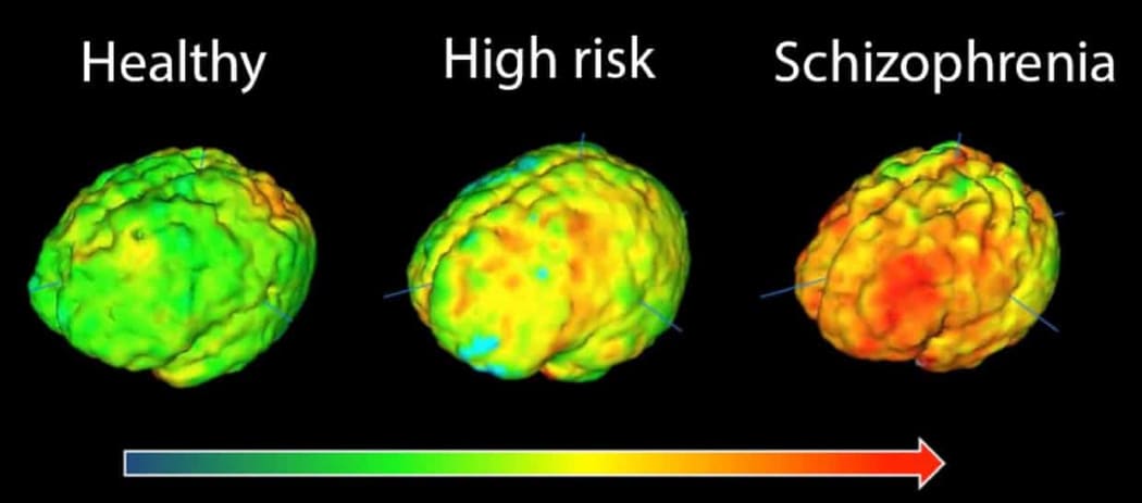 Brain images showing elevation in microglial activity in orange/red. The highest levels in schizophrenia are in the frontal cortex and the temporal cortex.