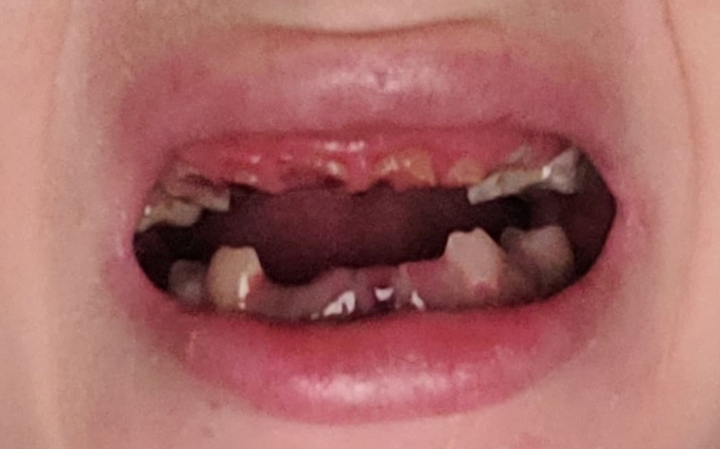 Ellie's ex-partner broke almost all of her teeth, and she cannot afford to get them fixed.