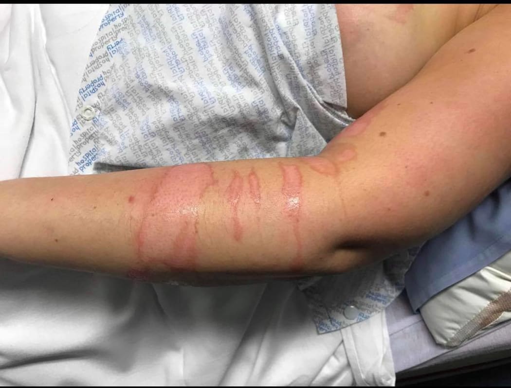 Burns on a nurse's body after she was attacked by a patient at Hillmorton Hospital in Christchurch.