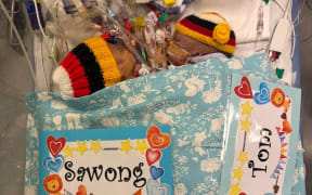 Papua New Guinea conjoined twins.