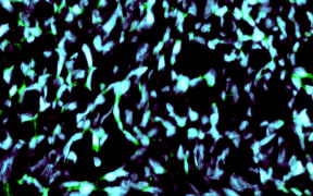 Nanoparticles in Glioma Cell Nuclei