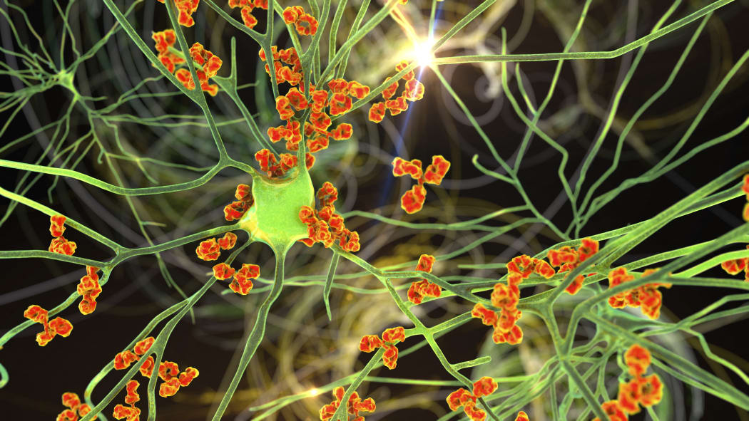 Antibodies attacking neurons. Conceptual computer illustration of autoimmune neurologic diseases.