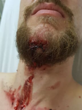 Liam Thompson, 27, was left him with a broken jaw, scrapes across his chest and wrists after an accident on a Lime e-scooter he was riding.