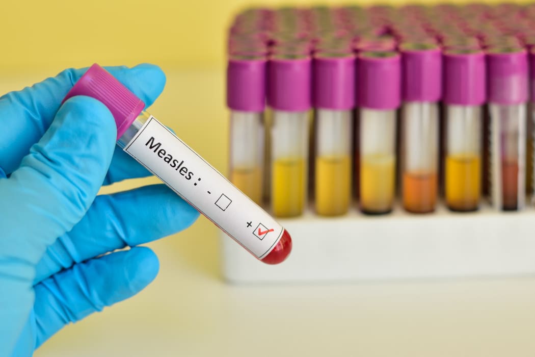 Testing for mumps