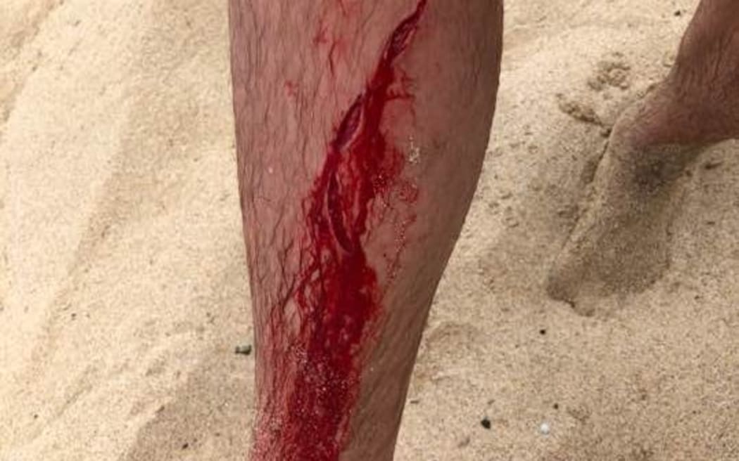 Dylan McWilliam's leg after he was bitten by a shark.