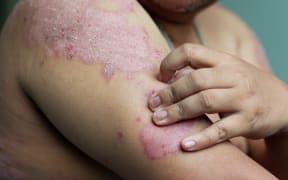 Men use their hands to scratch the wound in their arms. Diseases caused by abnormalities of the lymph. Psoriasis is a skin disease. Select focus shallow depth of field and blurred background