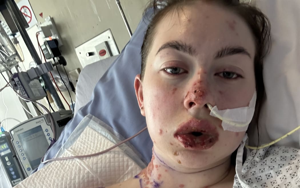 Charlotte Gilmour, 23, spent a month in Palmerston North Hospital being treated for Stevens-Johnson syndrome.