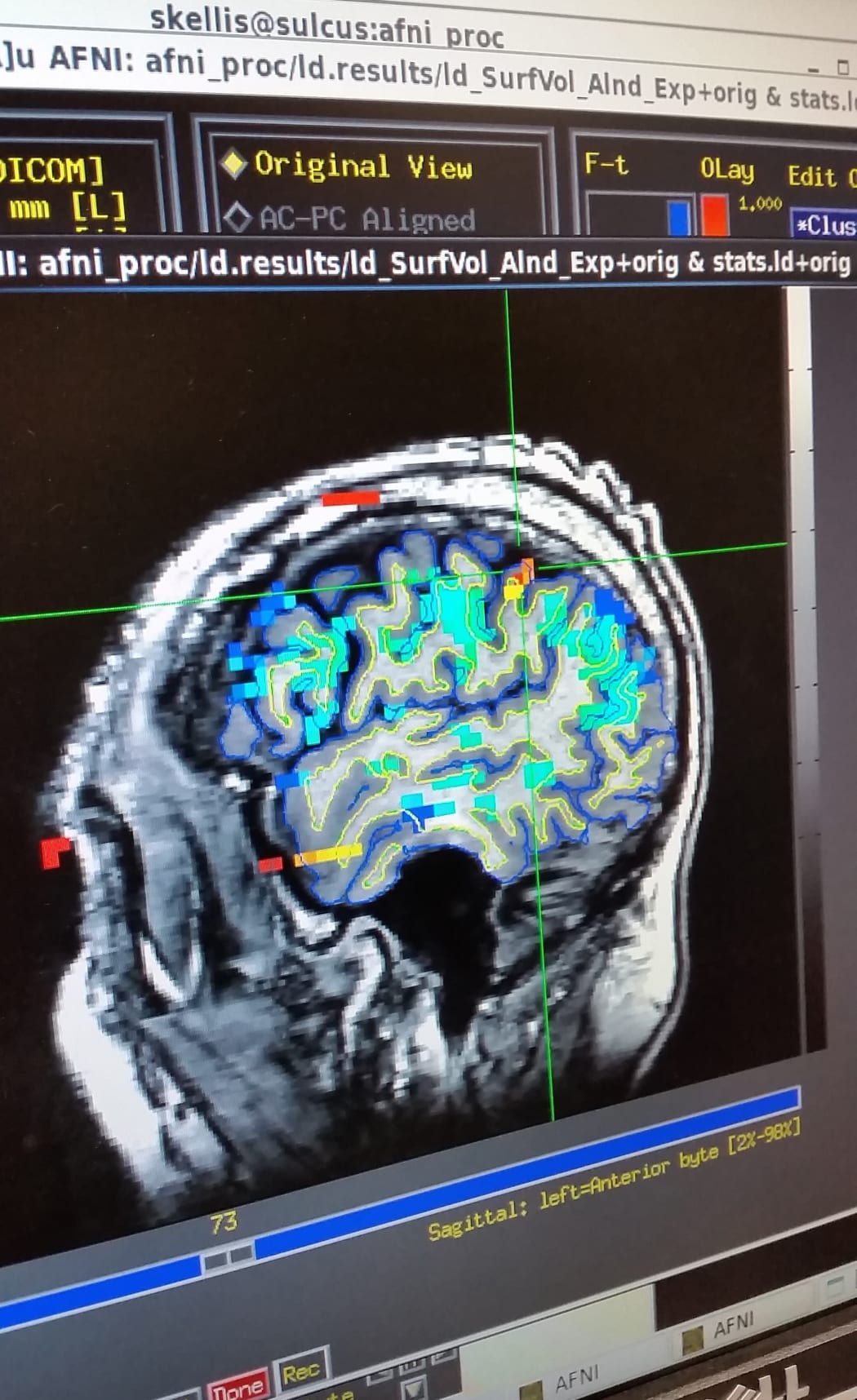 An MRI scan is used to target the right location to implant the device.