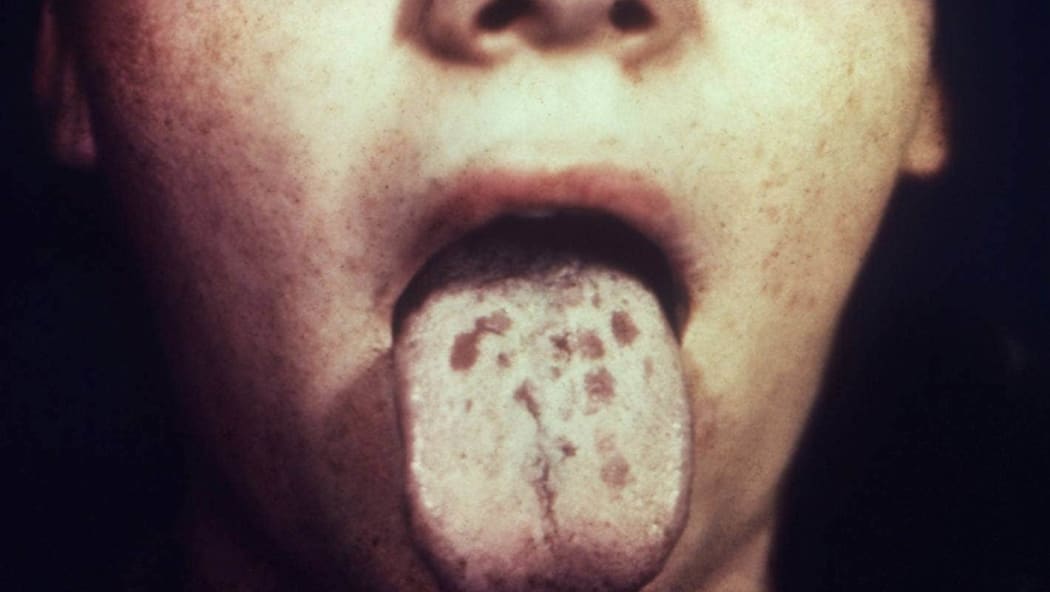An historic photo from the US of a patient's ankle with coin shaped lesions caused by secondary syphilis.
