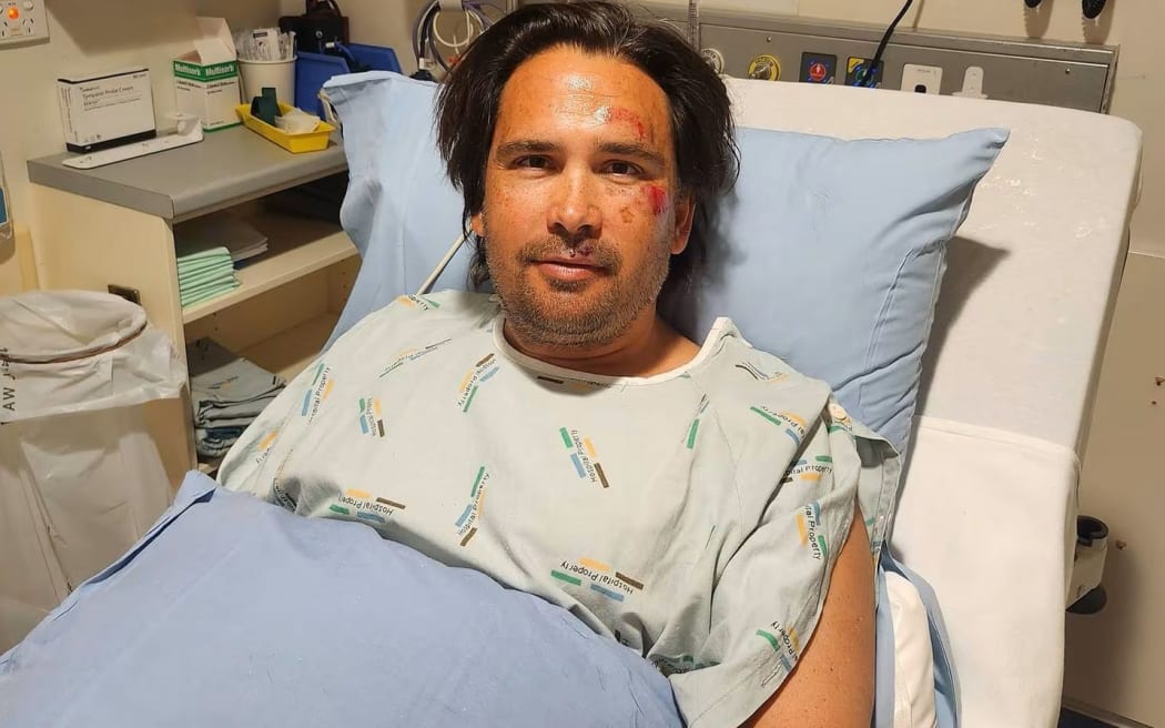 Simon Bridges after scooter accident