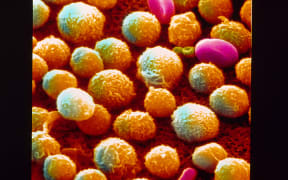 Chronic leukemia as seen under a scanning electron microscope.