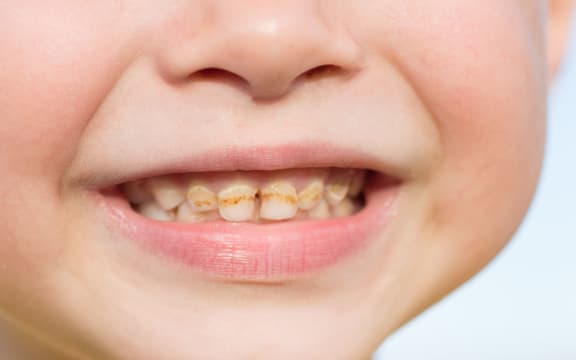 Close up child caries