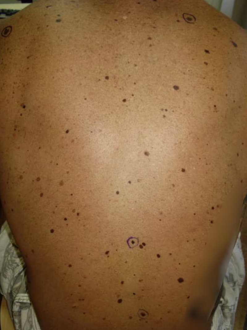 Abnormal moles seen developing in patients chasing perfect suntan by using  peptide melanotan-II
