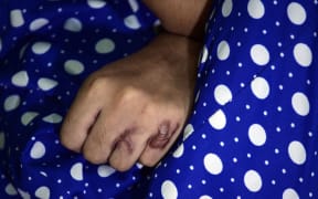 Burn marks on the hand of Indian acid attack survivor.