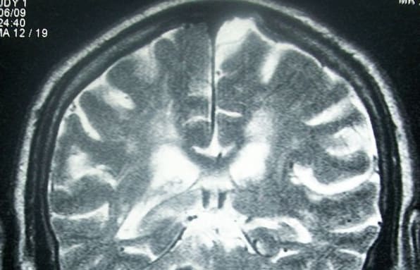 Head MRI showing deep intracerebral hemorrhage (cerebellum)