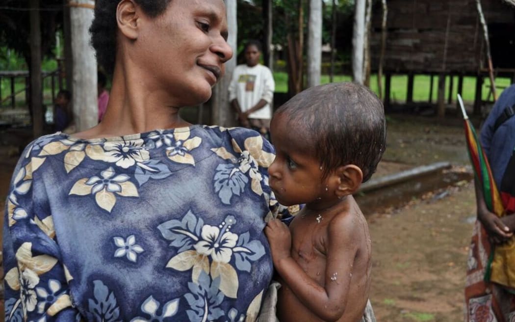 A mother and her malnourished child, Bimadbn Village, Morehead, Western Province, Papua New Guinea.