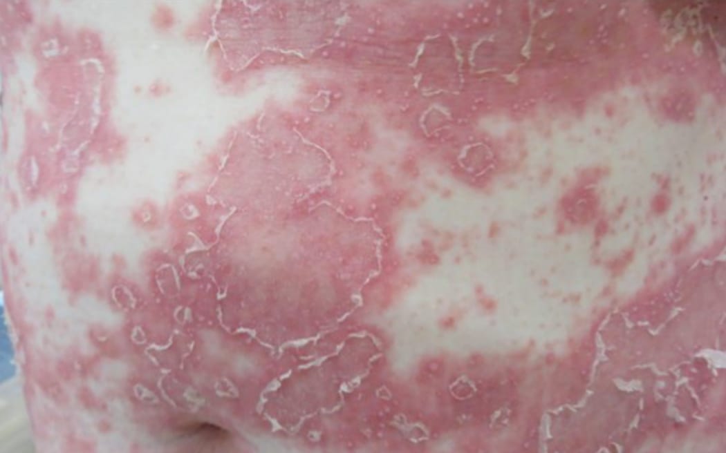 The abdomen shows a patchy and confluent erythematous rash studded with fine pseudo-pustulosis and peeling.