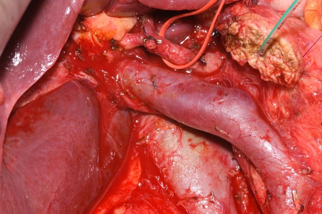 Pancreatic cancer operative photograph