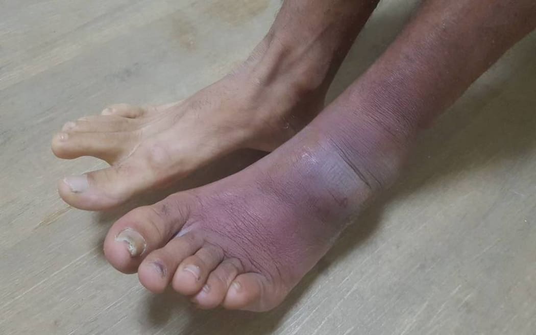 The ailing foot of a Manus refugee.