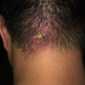 The tiny cut from the barber's clippers was infected and grew into a significant boil on the back of Lee Runga's head.