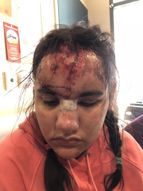 Rachel Nelson needed 15 stitches in her face after falling on concrete during a seizure.