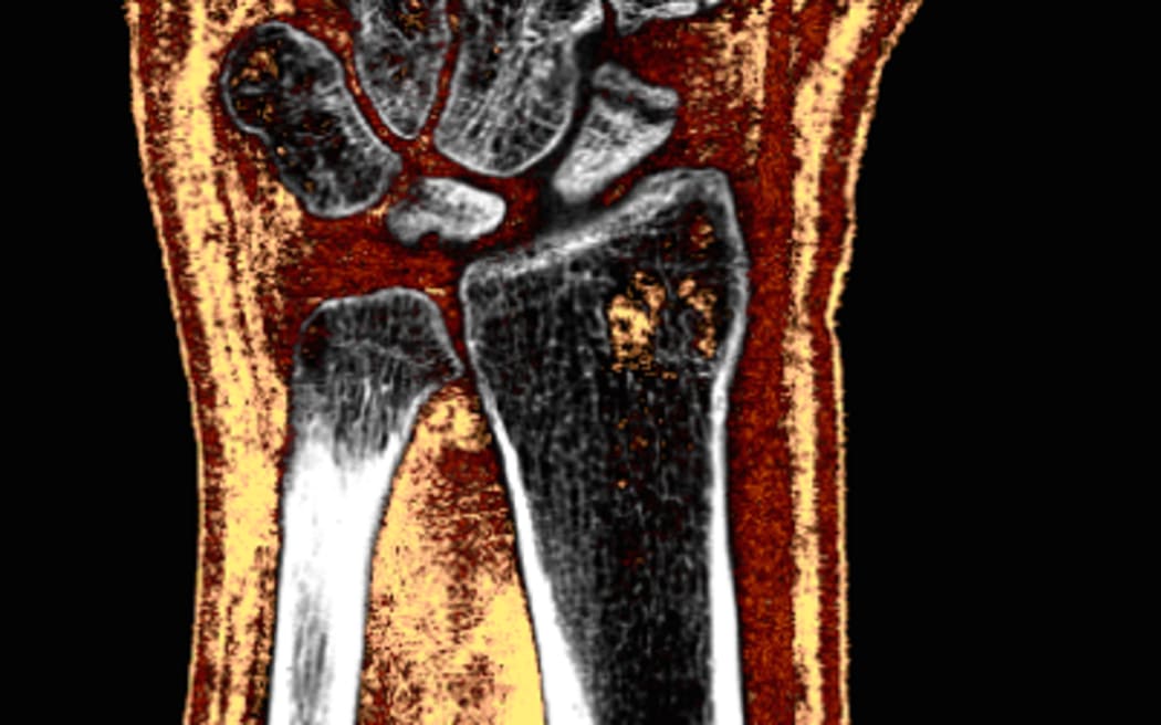 MARS scan of a wrist with a scaphoid fracture