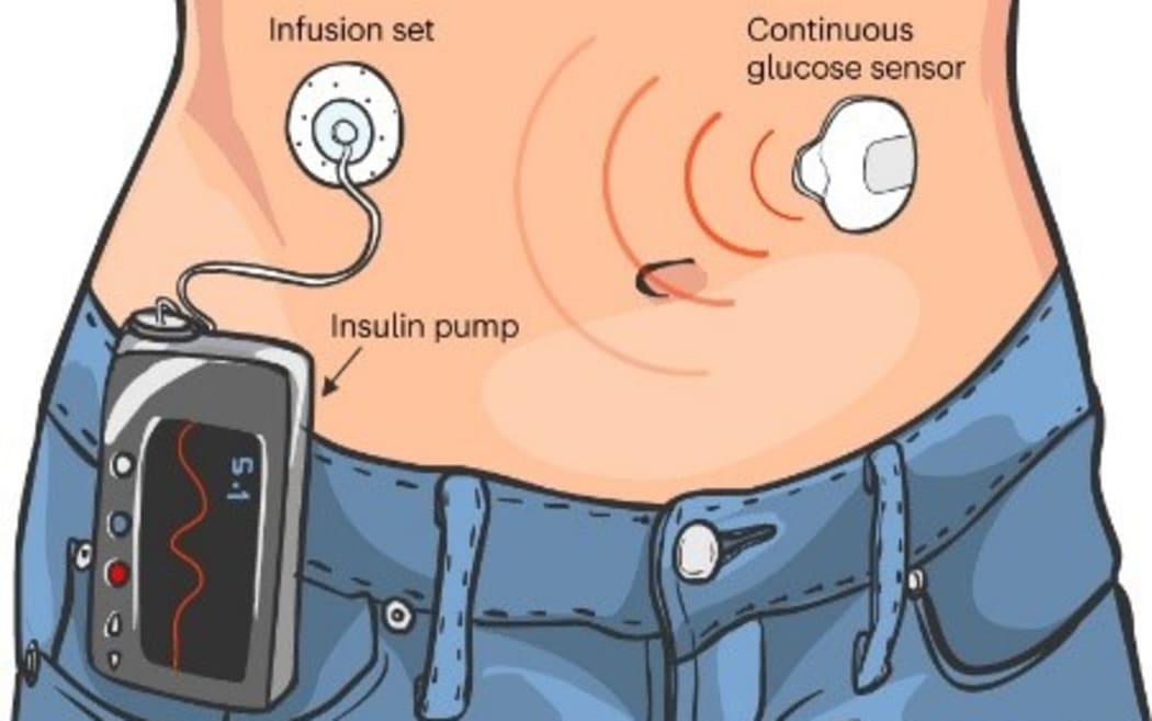Automated insulin delivery technology.