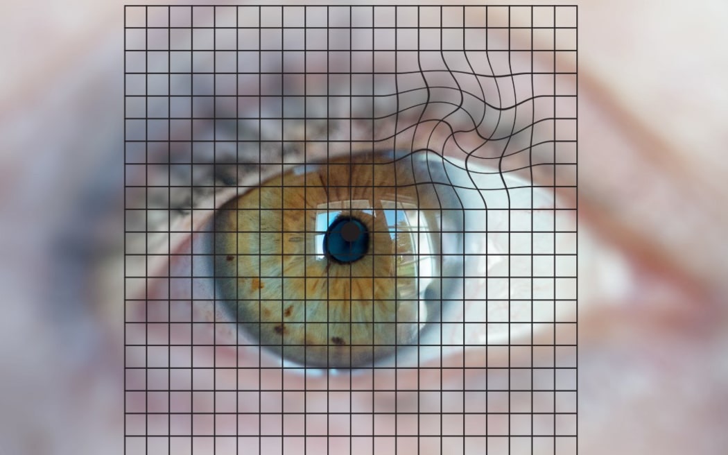 Amsler grid used to detect the Macular Degeneration Related to Age (MDRA). 
 

GARO/PHANIE