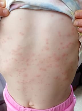 Sea bather's eruption on a child after swimming at Takapuna Beach.