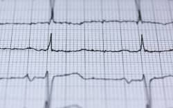 Electrocardiogram